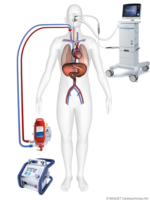⁦אקמו – ECMO  ELSO⁩ – תמונה ⁦2⁩