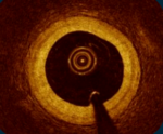 ⁦OPTICAL COHERENCE TOMOGRAPHY⁩ – תמונה ⁦3⁩