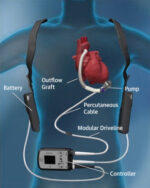 ⁦לב מלאכותי – LVAD⁩ – תמונה ⁦5⁩