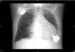 ⁦לב מלאכותי – LVAD⁩ – תמונה ⁦3⁩